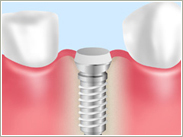 インプラント
