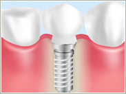 インプラント