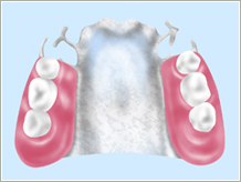 金属床入れ歯(チタン)