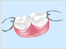 部分入れ歯（バネ）

