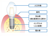 インプラントで解決しましょう！